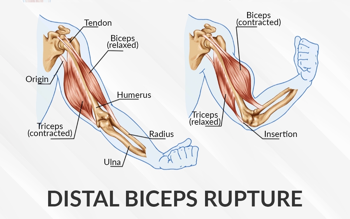 Distal Biceps Rupture Dr Saurabh Aggarwal