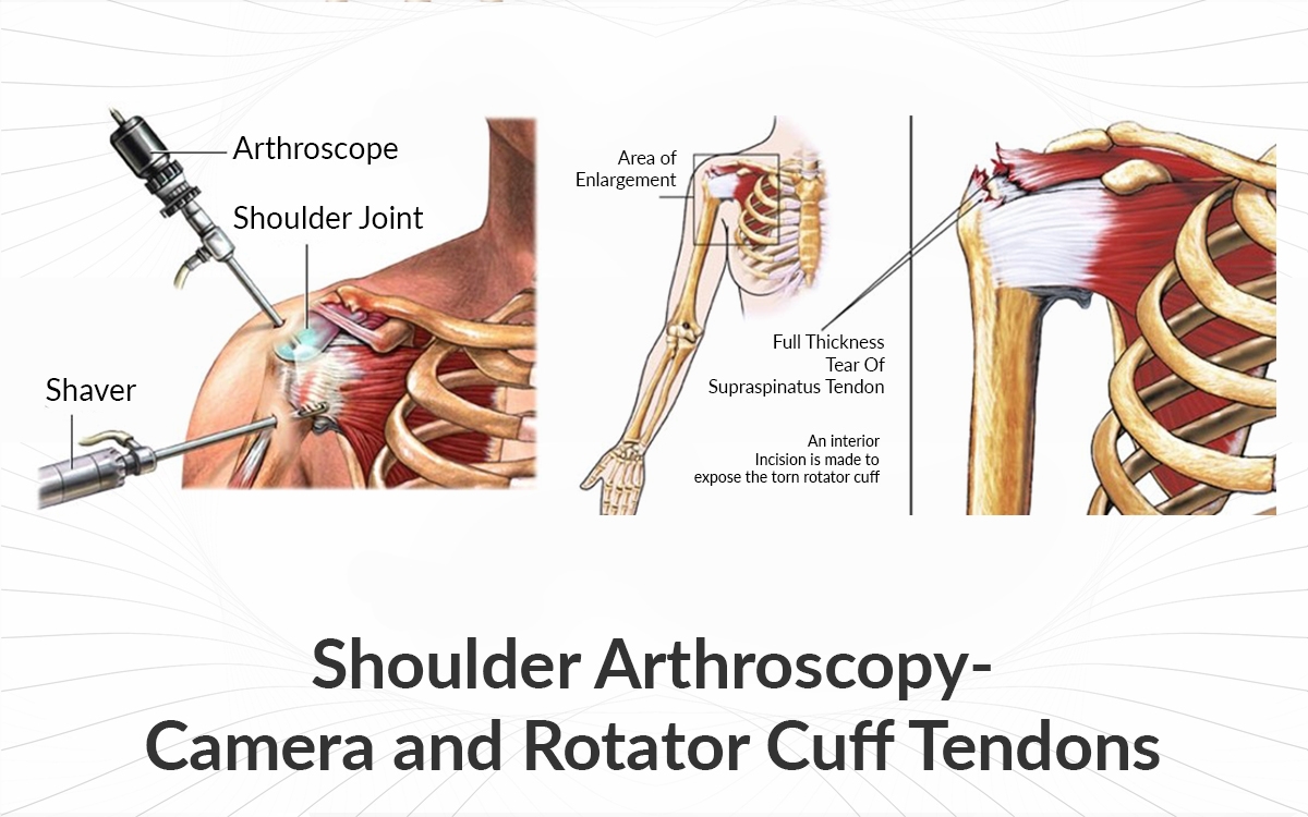 Arthroscopic Rotator Cuff Repair  Central Coast Orthopedic Medical Group